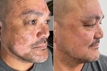 Découvrez comment choisir un praticien en dermopigmentation paramédicale