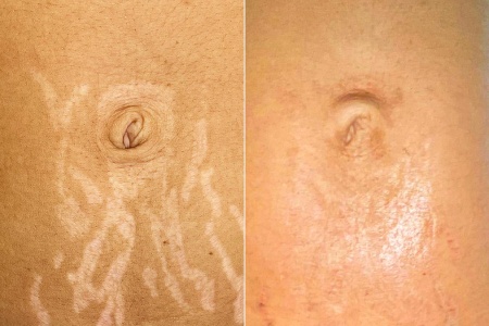 Discover the results of dermopigmentation on stretch marks