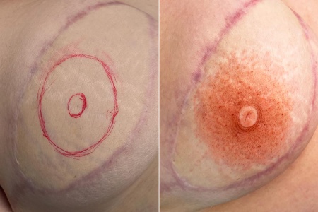 Découvrez le résultat de la dermopigmentation dans le cadre de reconstruction d'aréoles mammaire