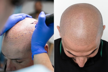 Discover the scalp micropigmentation to regain self-confidence.