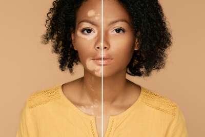 Dermopigmentation Center explains how to camouflage vitiligo
