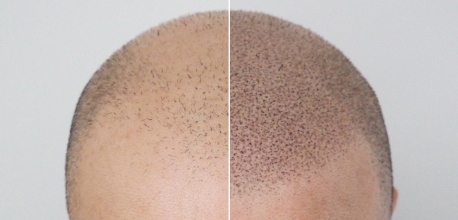 Dermopigmentation capillaire : avant - après 