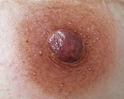 Reconstruction of super-realistic breast areola in Belgium