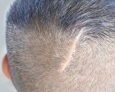Micropigmentation capillaire en Belgique: camoufler une cicatrice