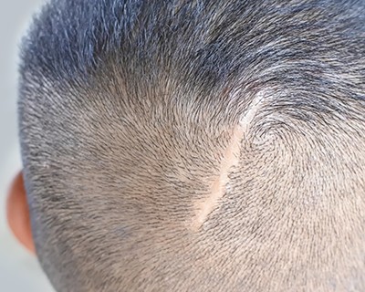 Scalp micropigmentation in Belgium: scar camouflage