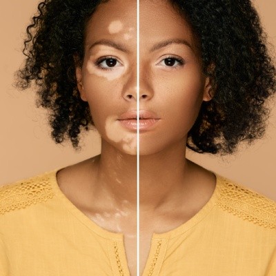 How do you camouflage vitiligo with dermopigmentation?