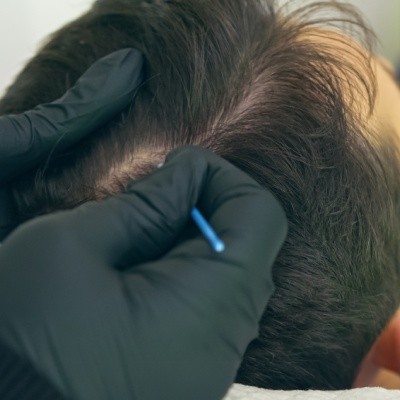 Densification des cheveux par micropigmentation : fonctionnement