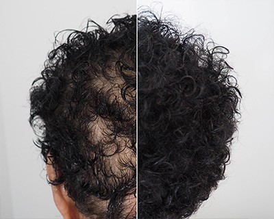 Hair densification by trico pigmentation in Belgium