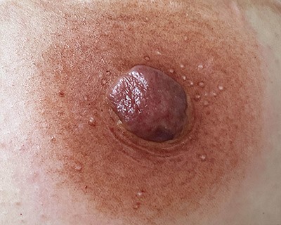  Breast areola reconstruction