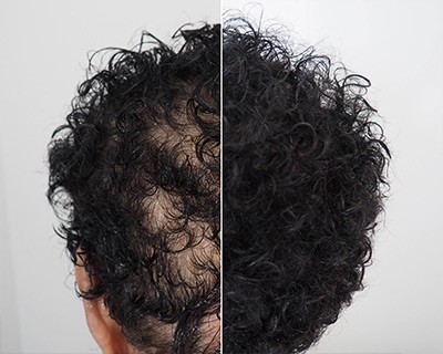 Hair densification