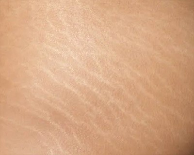 Correction of scars and stretch marks