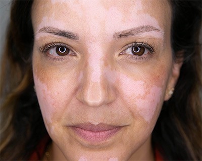 Covering up vitiligo