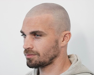 Scalp micropigmentation