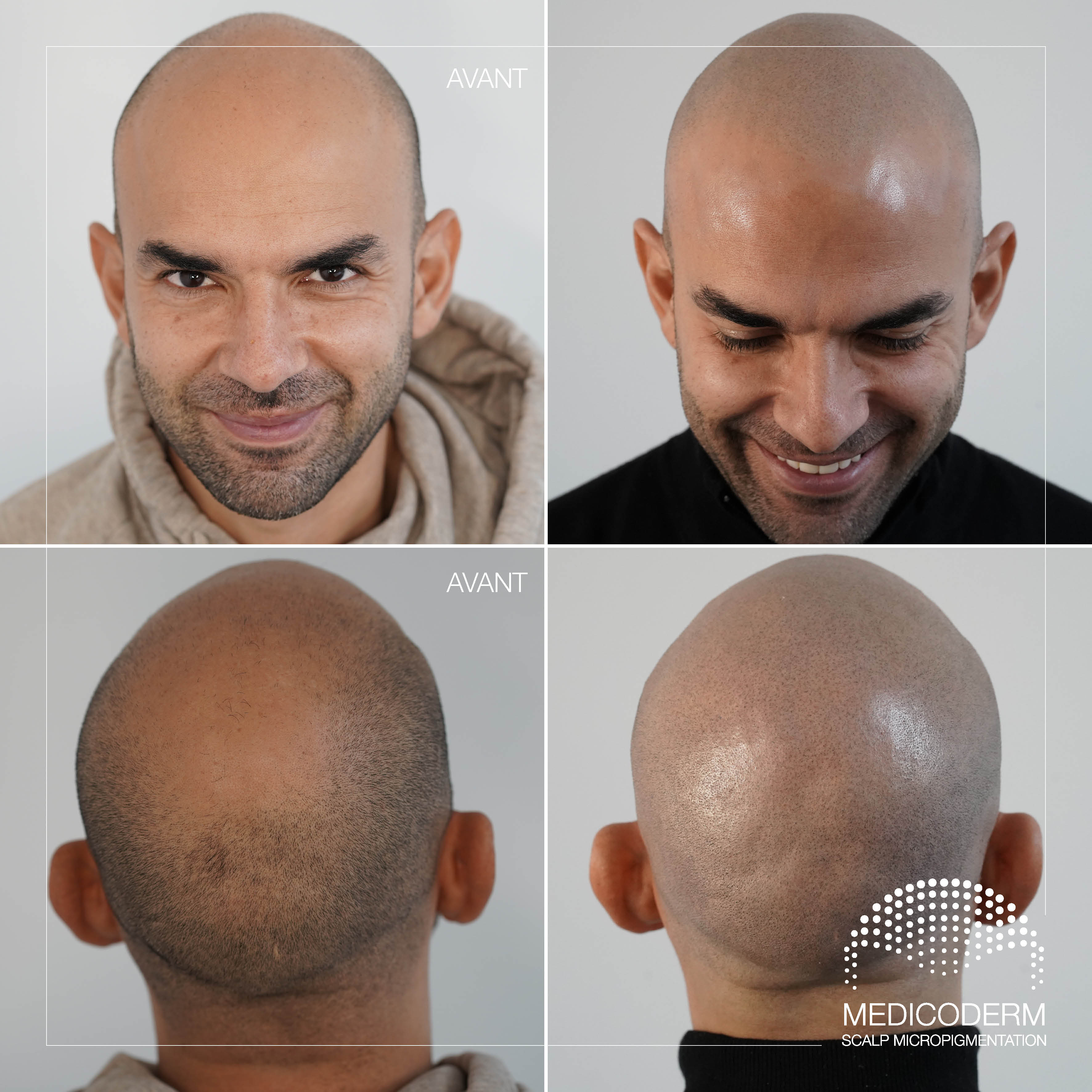 Micropigmentation capillaire, effet crâne rasé, en Belgique